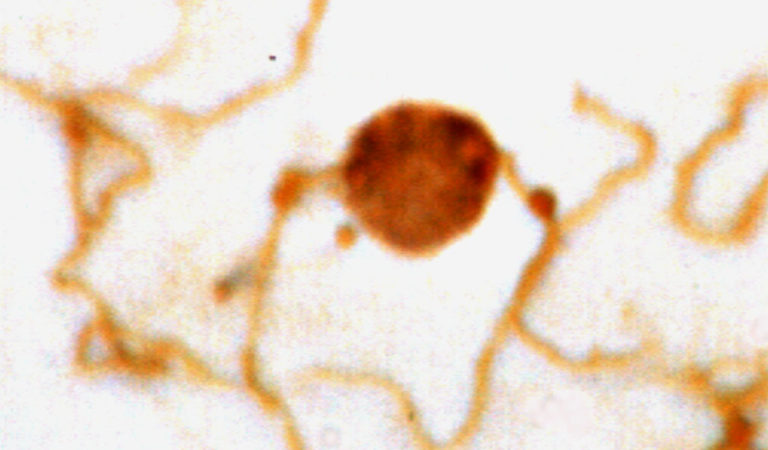 Lyme Borreliosis | Academy of Nutritional Medicine